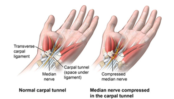 Can Hand Grippers Cause Carpal Tunnel? The Gripping Truth!